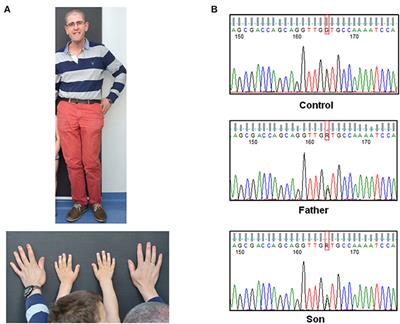 RNA Analysis and Clinical Characterization of a Novel Splice Variant in the NSD1 Gene Causing Familial Sotos Syndrome